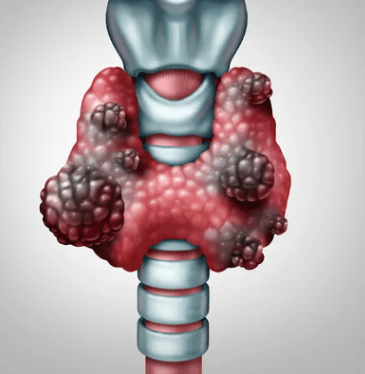 nodulo na tireoide maligno