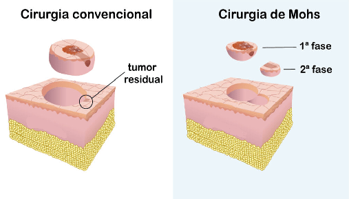 dr leonardo macedo cirurgia de mohs