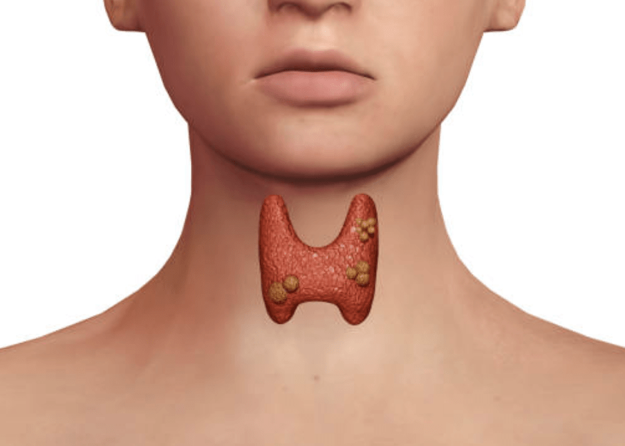 nodulos na tireoide - Dr Leonardo Macedo