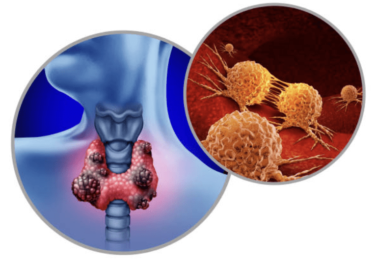 cancer de tireoide - dr leonardo macedo cirurgia da tireoide