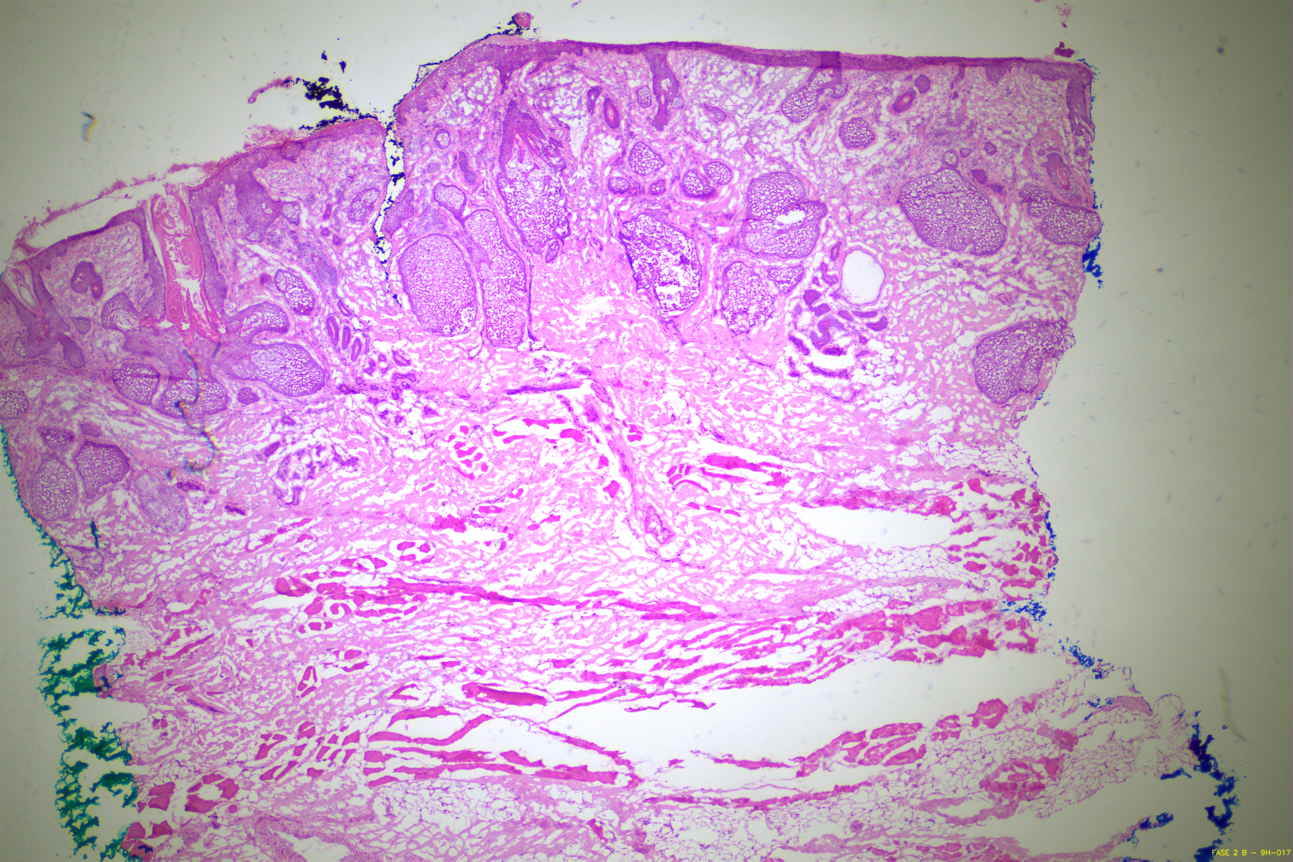 Cirurgia Micrografica de Mohs - Lâmina confeccionada durante uma de nossas cirurgias de Mohs em Araguaína-TO. Análise microscópica das margens cirurgicas durante a cirurgia - Medicina de precisão - Dr Leonardo Macedo