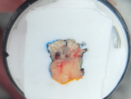 Cirurgia Micrografica de Mohs  Dr Leonardo Macedo - material preparado para corte horizontais de alta precisão durante a cirurgia. Resultado na hora da cirurgia.