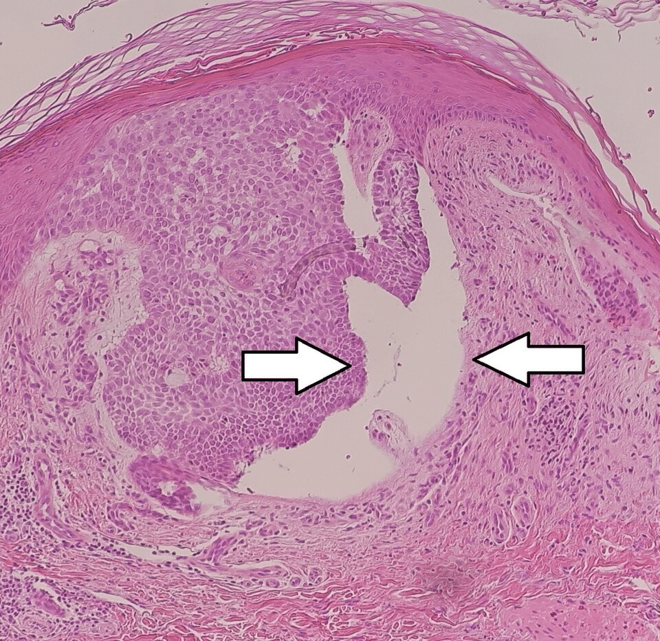 dr leonardo lamina carcinoma basocelular - cirurgia de mohs