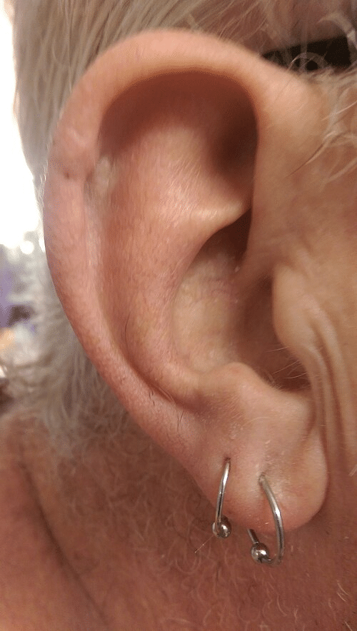 dr leonardo macedo resultado
carcinoma basocelular - cirurgia de mohs