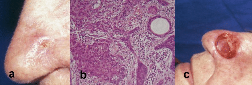 dr leonardo lamina carcinoma basocelular - cirurgia de mohs