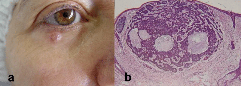 dr leonardo macedo lamina carcinoma basocelular - cirurgia de mohs