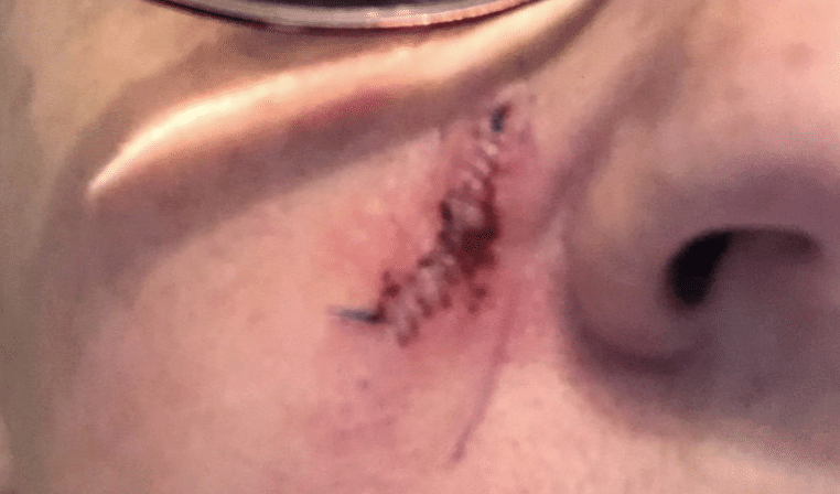 dr leonardo macedo
carcinoma basocelular - cirurgia de mohs
