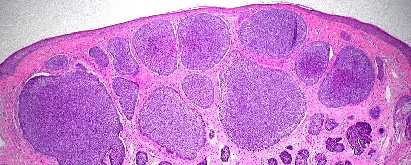dr leonardo lamina carcinoma basocelular - cirurgia de mohs
